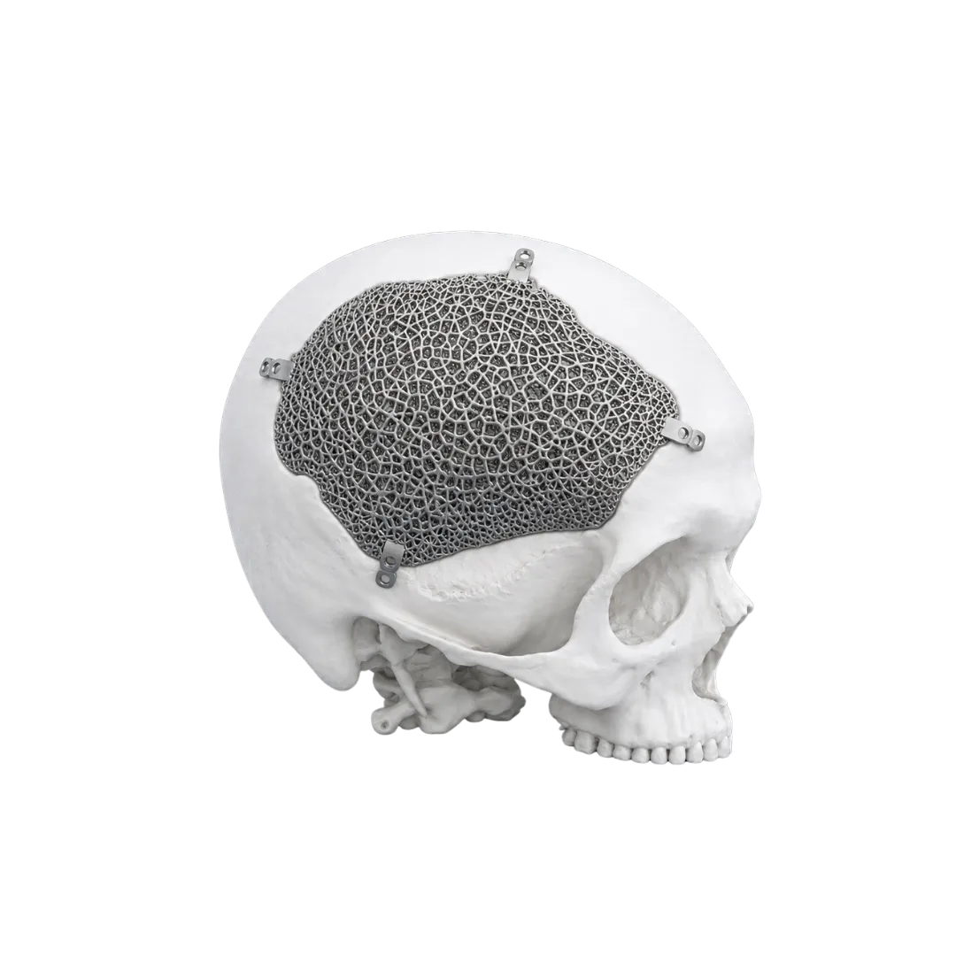 Prótesis craneal 3D a medida - Malla BBI de titanio