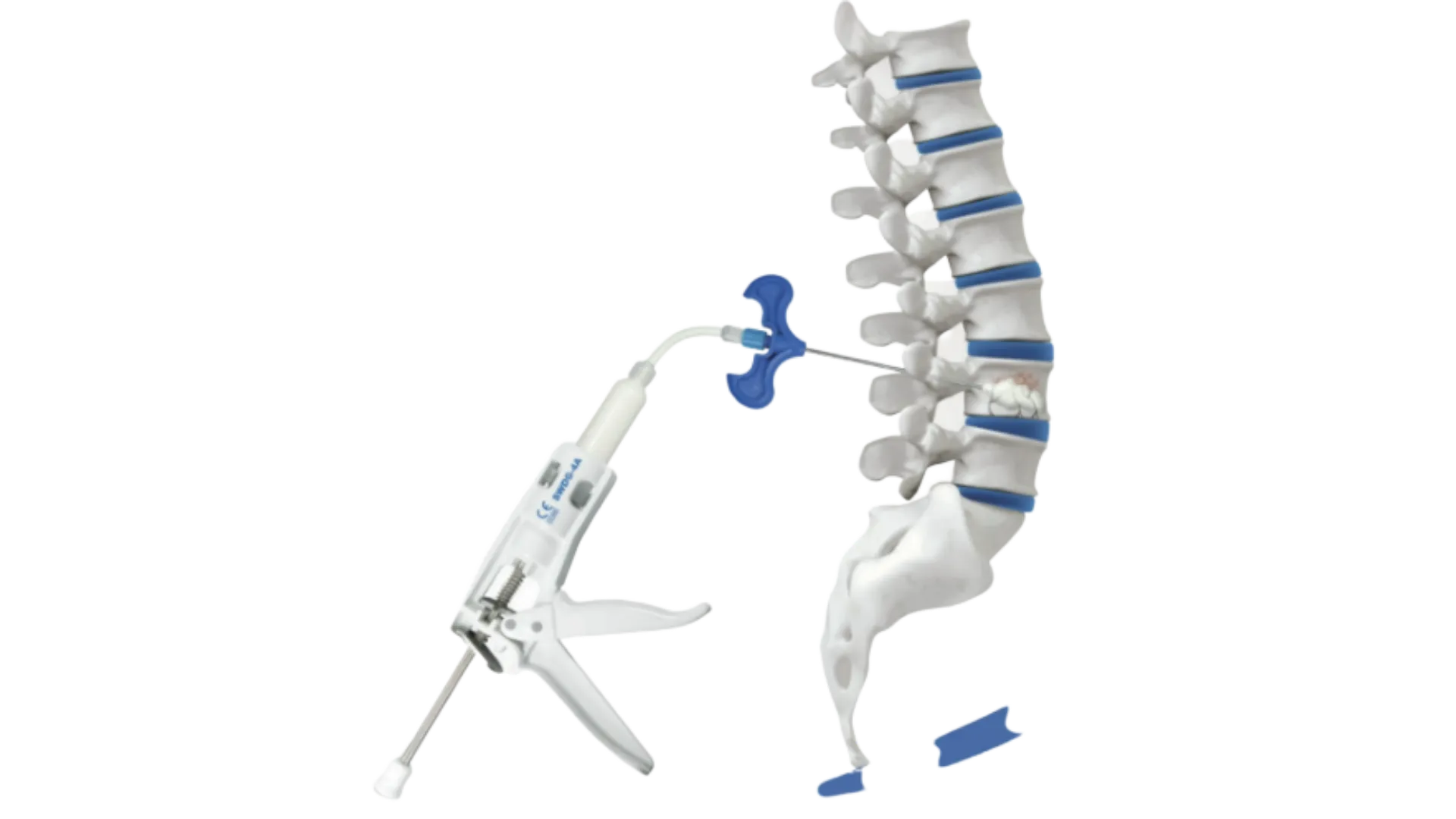 Set de vertebroplastia